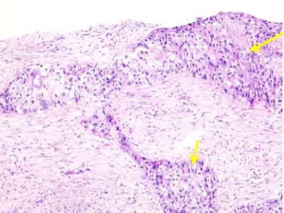 Case report: A rare case of anti-PD-1 sintilimab-induced agranulocytosis/severe neutropenia in non-small cell lung cancer and literature review
